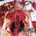 DISGORGE: Chronic Corpora Infest